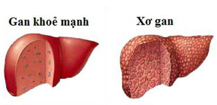 dieu-tri-xo-gan-bang-cay-an-xoa-1