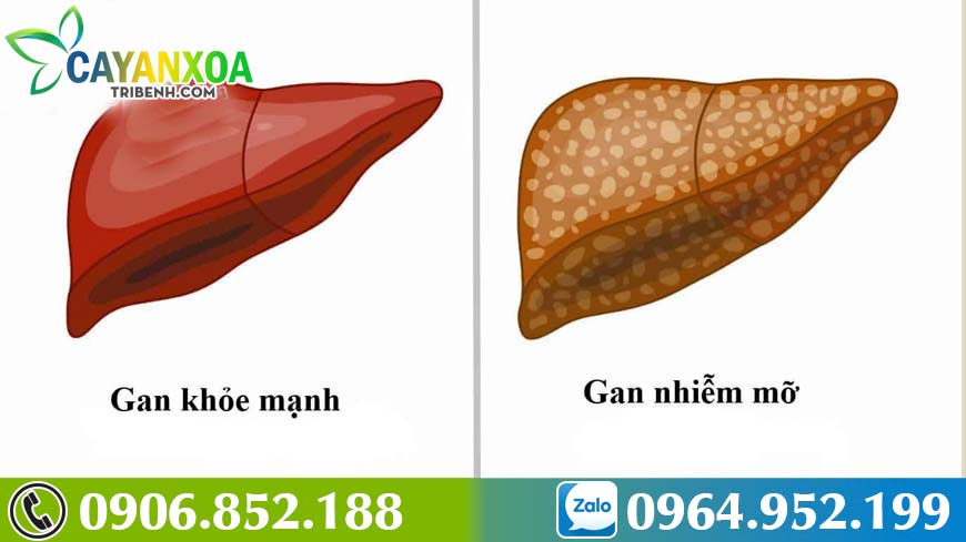 benh-gan-nhiem-mo-2