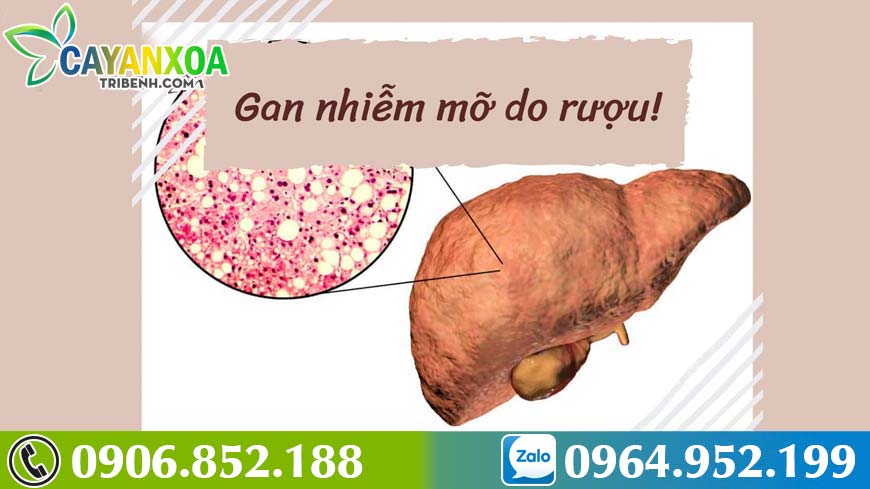 benh-gan-nhiem-mo